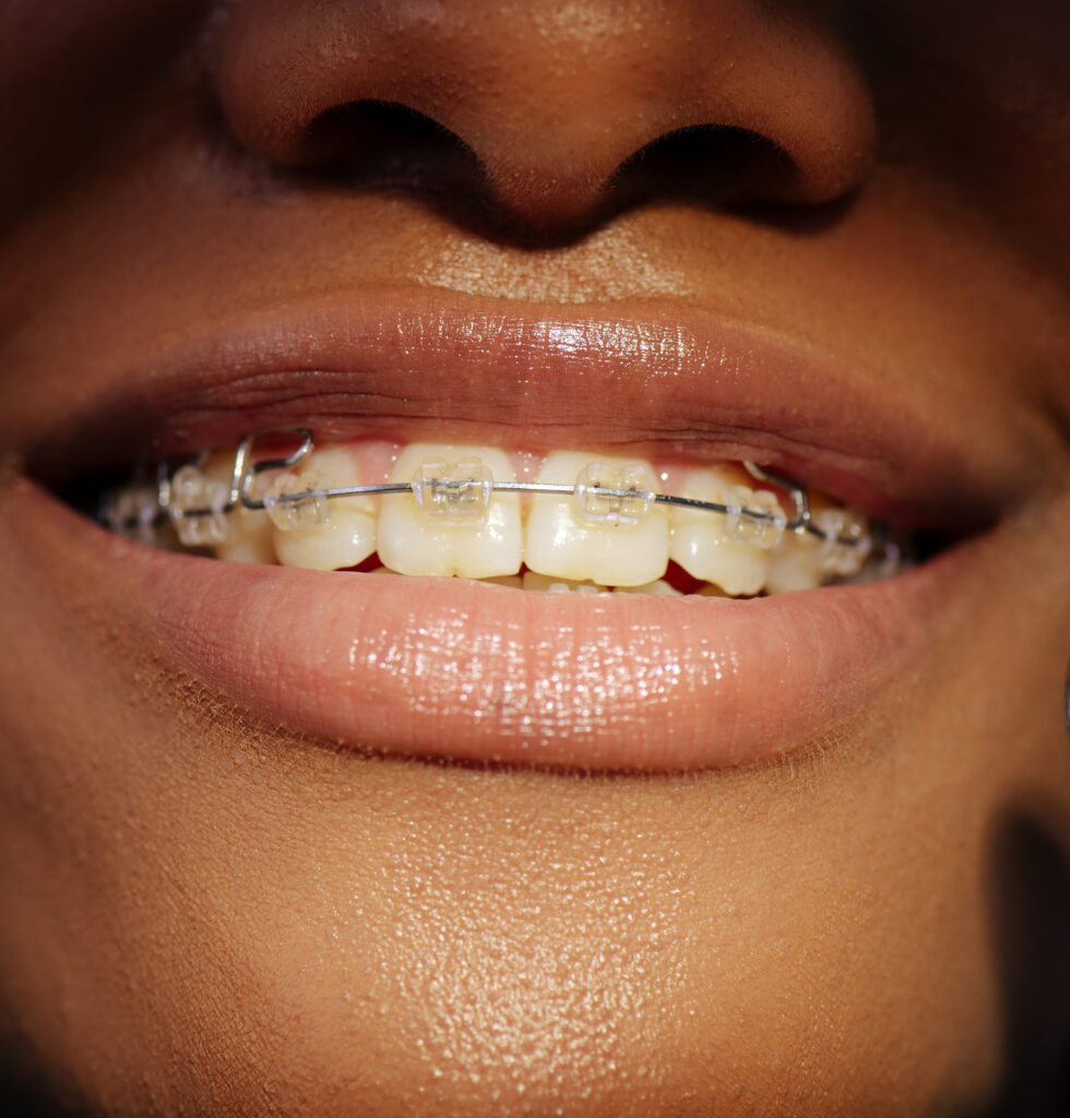Sourire avec un appareil orthodontique fixe